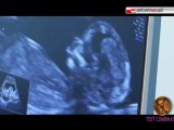 TG 12.01.11 Lo screening prenatale per la diagnosi delle malattie cromosomiche