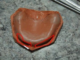 Como fazer um PLANO DE ORIENTAÇÃO para prótese total parte 1