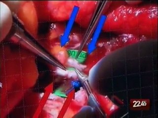 TG 14.01.10 Il San Carlo di Potenza, eccellenza al Sud