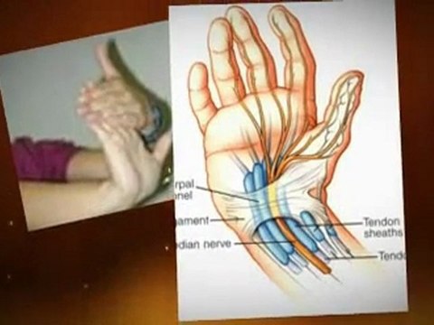 Carpal tunnel exercises are essential if you want a long lasting effect on relieving your carpal tunnel pain