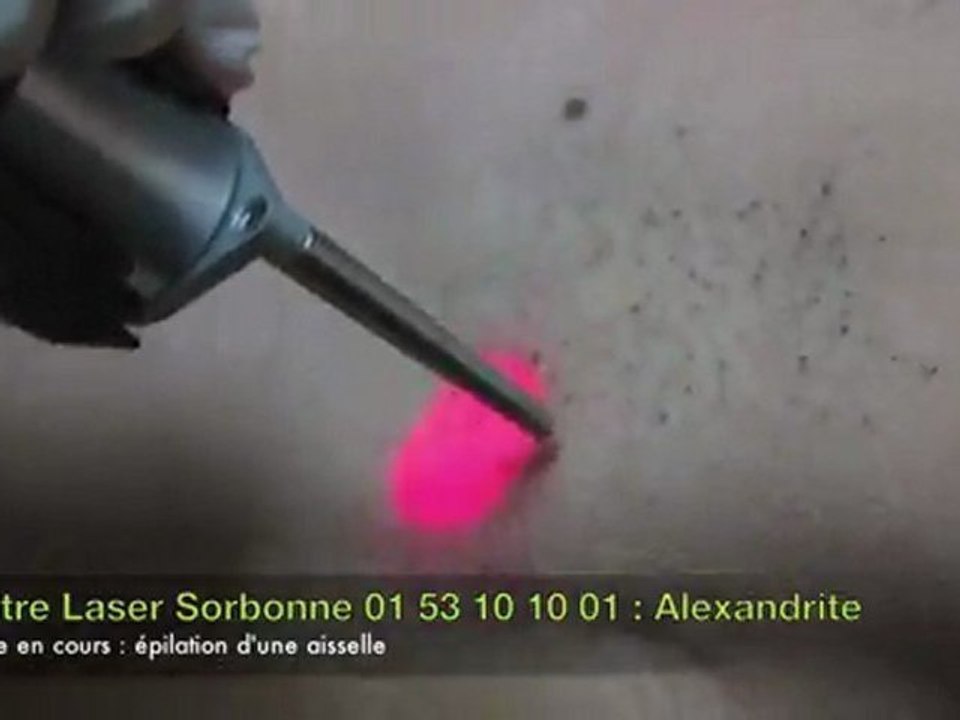 Vidéo Epilation laser définitive MPX Alexandrite