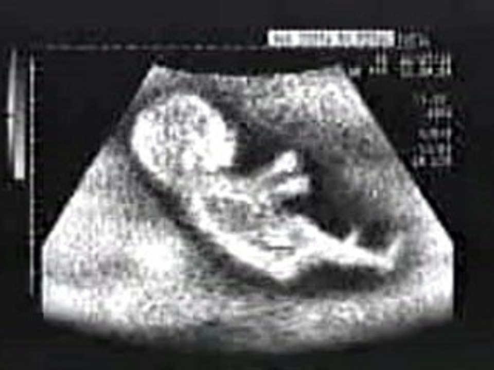 echographie babé en voiture