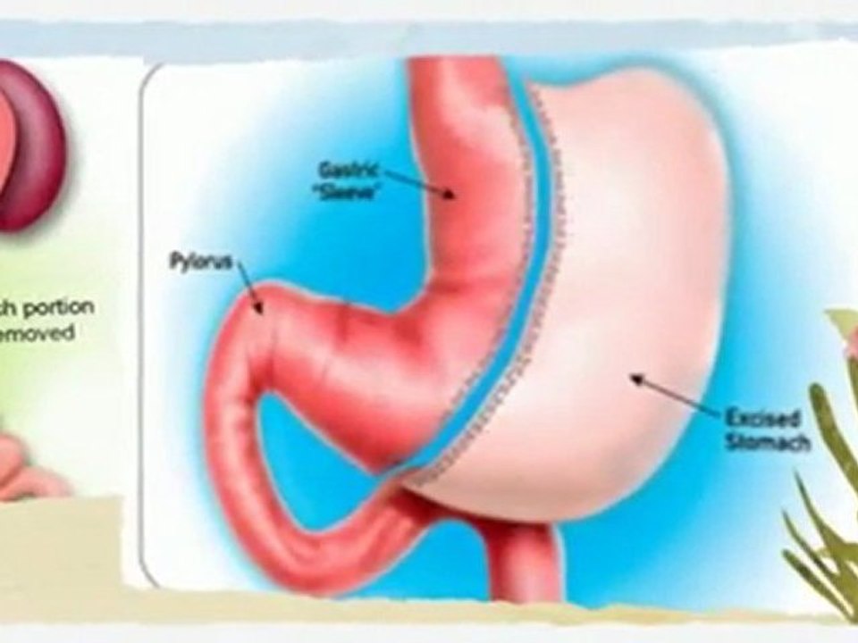 Gastric Sleeve Video