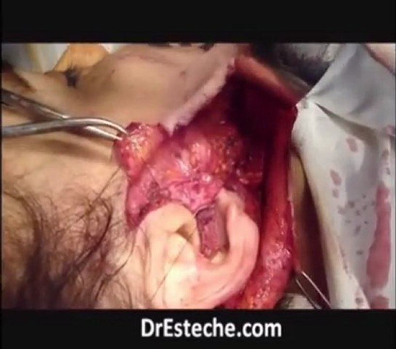 Musculos de la cara | Ritidectomia
