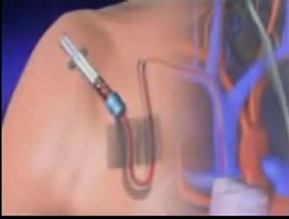 ANEMIE POST CHIMIOTHERAPIE version arabe-Dr. AMINE A. -