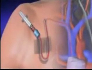 ANEMIE POST CHIMIOTHERAPIE version arabe-Dr. AMINE A. -