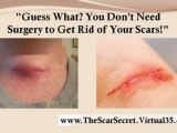 scar removal cream - natural scar treatment - pimple scar removal