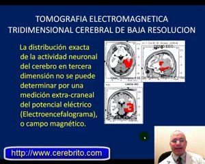 Demostración del VideoElectroencefalograma, EEG, Mapeo Cerebral y Tomografía Electromagnética Tridimensional Cerebral de Baja Resolución