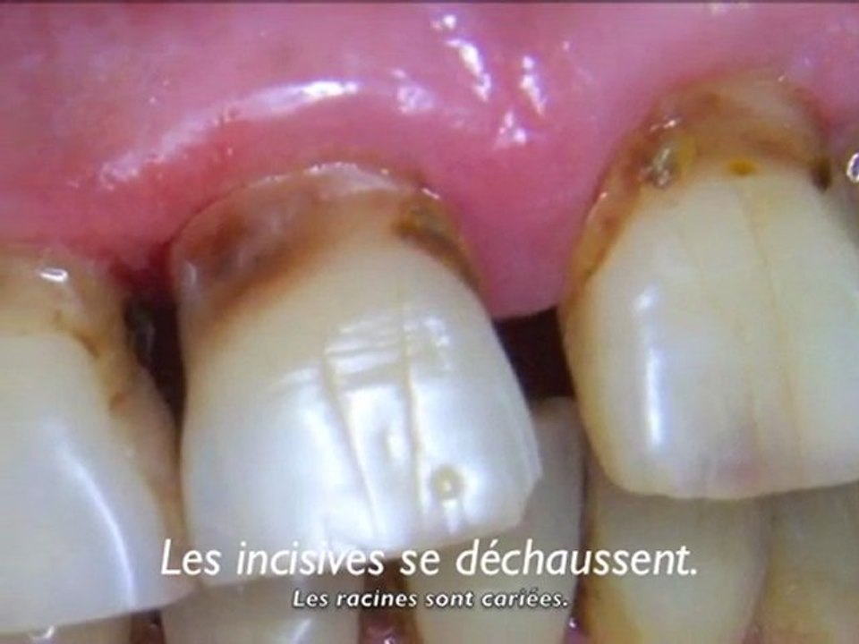 Les facettes dentaires et leurs indications