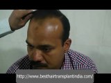 Hair Loss Treatment India, Hair Transplant