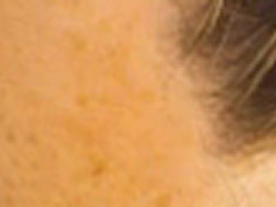 Hair Loss Remedies | How to Stop Hair Loss | Alopecia Hair Loss