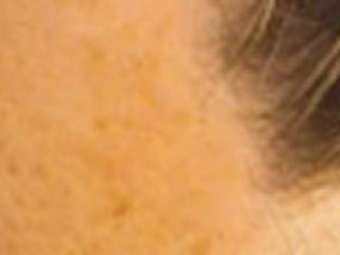 Hair Loss Remedies | How to Stop Hair Loss | Alopecia Hair Loss