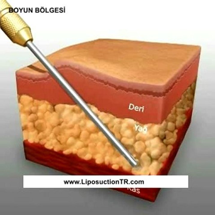 Liposuction Boyun-Bolgesi