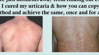 adrenergic urticaria - urticaria chronic - chronic idiopathic urticaria - severe urticaria
