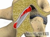 Cervical Spine Pathology Rheumatoid Arthritis Spondylitis medical trial exhibits 3D animations
