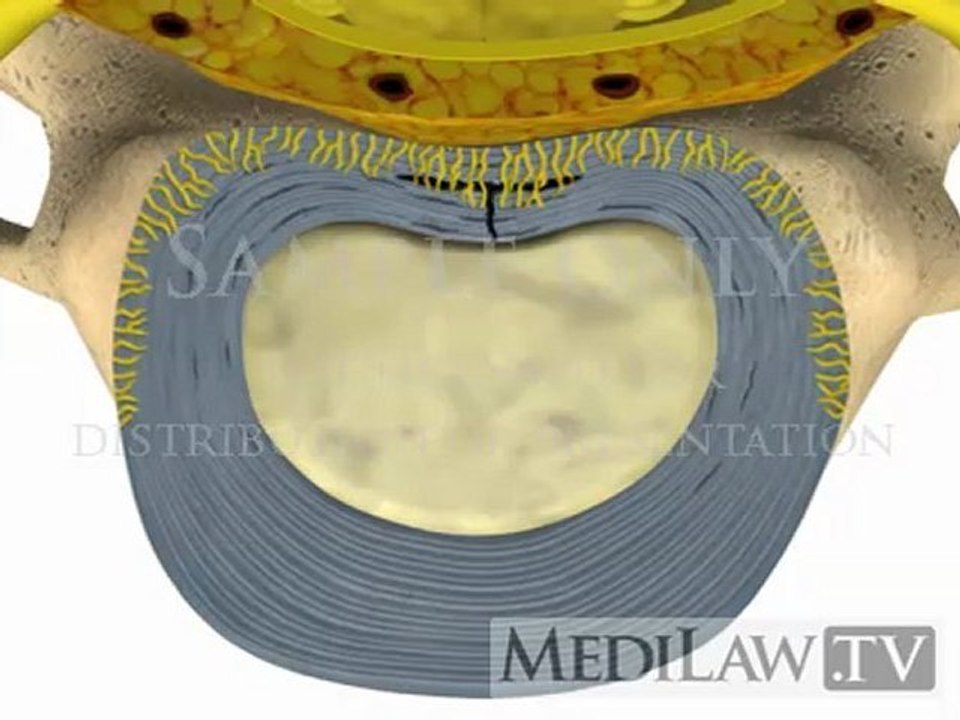 Cervical Spine Pathology Intervertebral Disc Annular Circumferential