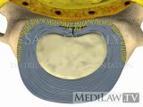 Cervical Spine Pathology Intervertebral Disc Annular Circumferential Tear physical therapy 3D animations