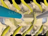 Cervical Spine Vertebrectomy Corpectomy with bone + plate neurosurgery 3D animations