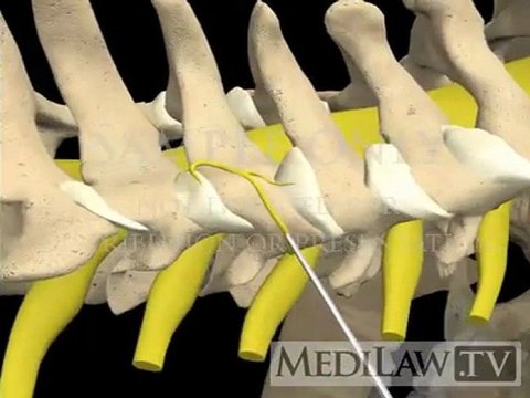 Cervical Spine Medial Branch Nerve Neurolysis pain management 3D animations