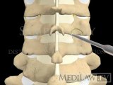 Cervical Spine Facet Joint Foraminotomy orthopaedic surgery 3D animations