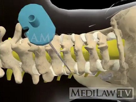 Cervical Spine Medial Branch Nerve Block orthopaedic surgery animations