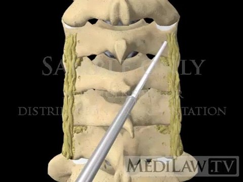 Cervical Spine Lateral Mass Screw Fusion Fixation neuro-surgical videos