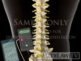 Lumbar Spinal Cord Trial Stimulation wire electrode neuro-surgery animations