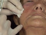 “Facelift By Syringe” by Z. Paul Lorenc, M.D.