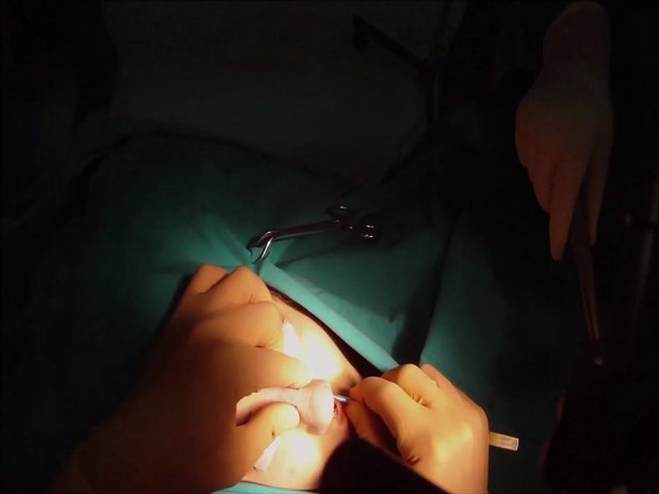 Rhinoplasty Procedure 2