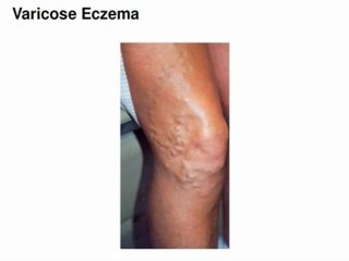 eczema natural treatment