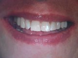 Dental Implants Austin, TX Lakeway Before & After photos teeth