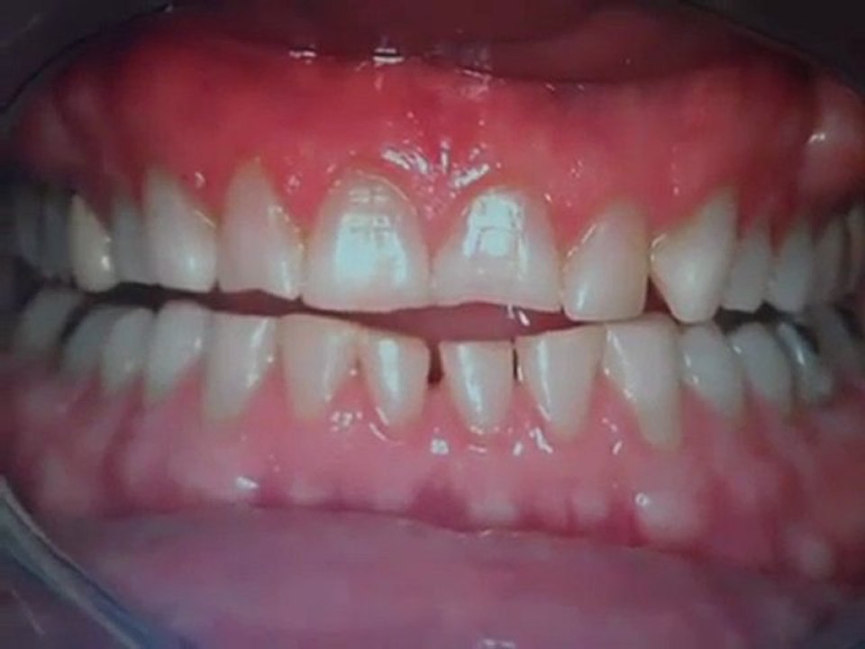 Porcelain Veneers- Dental Restoration- Austin Tx, Lakeway Dentist