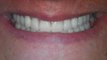 Cosmetic Dentures & Partial Dentures-Austin TX Before and After Pics