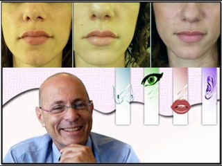 עיבוי שפתיים - טיפול קל עם תוצאות מדהימות