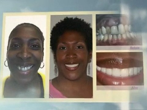 Dental Implants Philadelphia