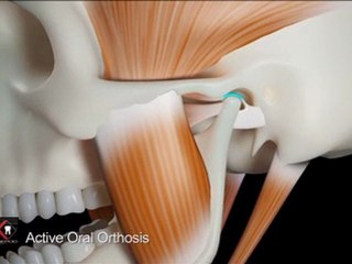 Oral active orthosis and active, orthodontic teat (KINEPOD)