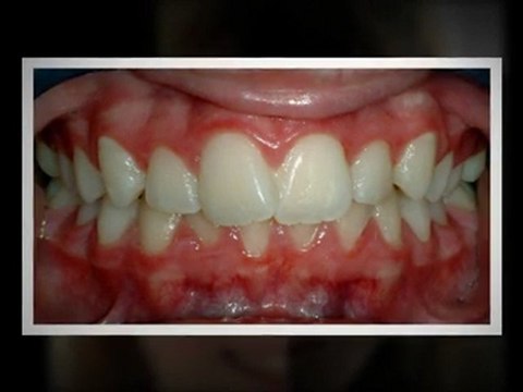 Invisalign Littleton Sept2011