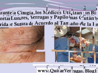 verrugas tratamiento natural