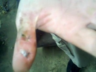 Jimmy McDuff Attempts to Remove His Hand