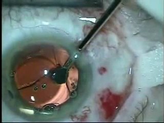 Implantlenzen behandeling IOL Exchange Mplus