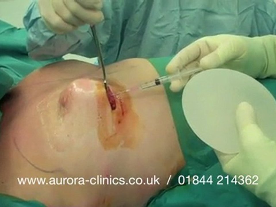 Breast Implant Removal and Implant Replacement