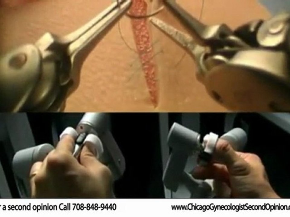 Chicago Hysterectomy Second Opinion and Robotic ...