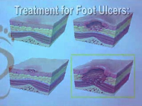 Foot Ulcers - NYC Manhattan Podiatrist and White Plains, NY
