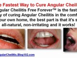 home remedies for angular cheilitis - angular cheilitis remedies