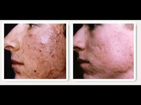 Eliminar Acne para siempre - quitar espinillas