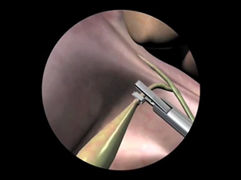 The Truth About Surgical Mistakes and Laparoscopic Gallbladder Surgery  - Surgery Mistakes Pt.1
