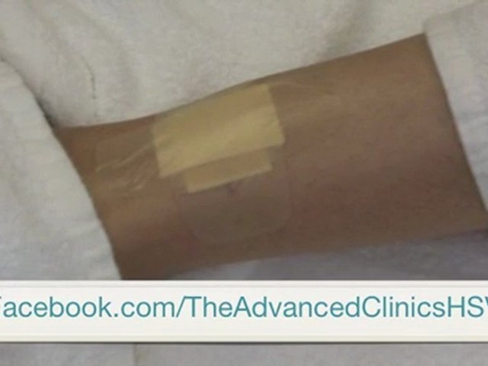 Huntsville Laser Tattoo Removal, Sunburst on Ankle 5