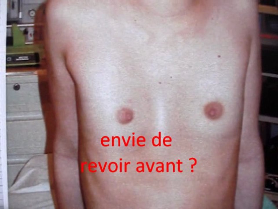 prothèses mammaires réparatrices par vladlmir mitz/breast augmentation for funnel chest