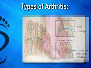 Arthritis Foot Care - NYC  Manhattan and White Plains, NY Po