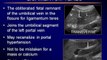 Ultrasound of the Liver part 2